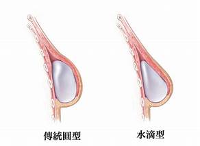 果凍矽膠隆乳手術費用