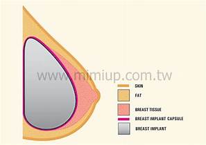 果凍矽膠隆乳手術後成球狀